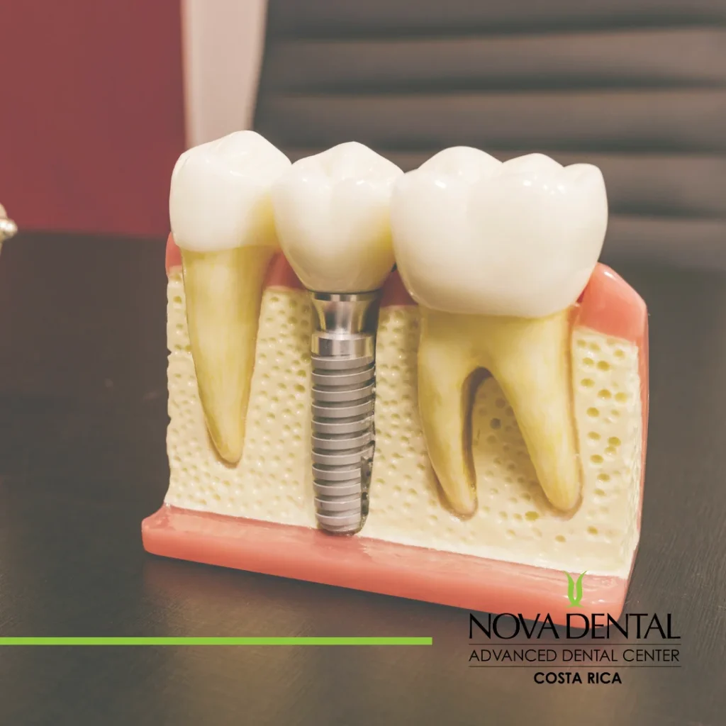Mini dental implants
