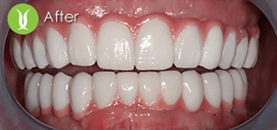Restorations-with-Dental-Implants-and-Full-Zirconia-Bridges1_after