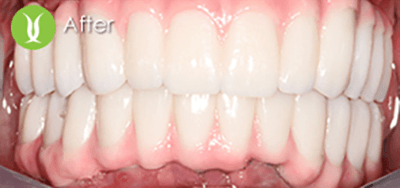 before-after-full-mouth-20_after