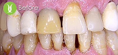 full-mouth-resto-implants-1_before full-mouth-resto-implants-1_before