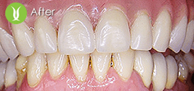full-mouth-resto-implants-2_after