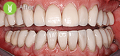 full-mouth-resto-porcelain-crowns-7_after